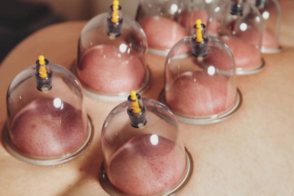 Cupping Techniques